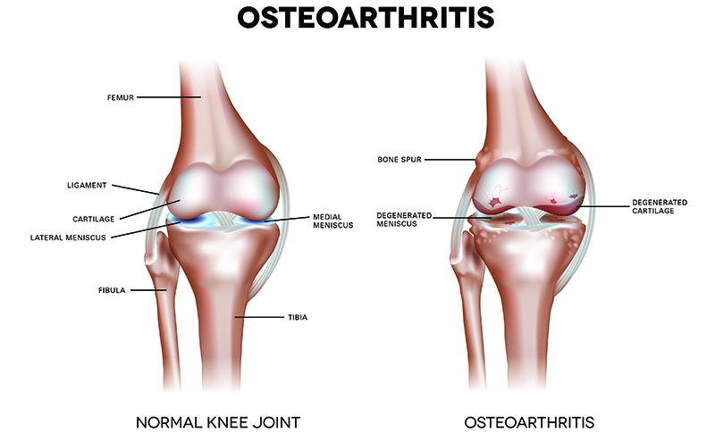 Osteoarthritis Diagram
